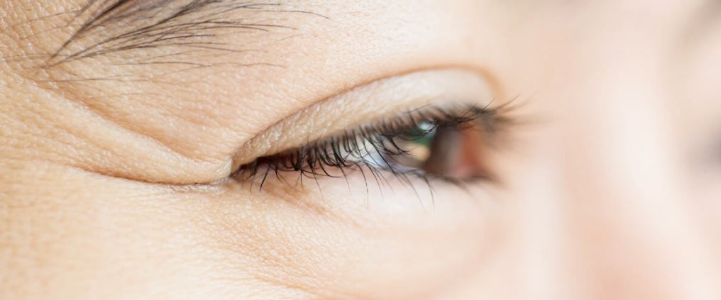 addressing crows feet